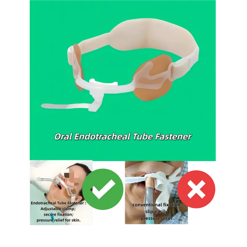 قفل الأنبوب الرغامي
