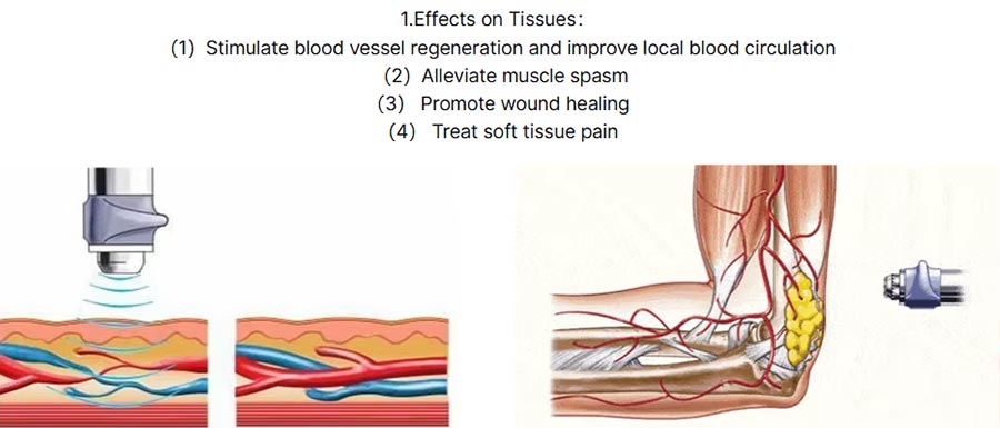Single Channel Shock Wave Therapy System