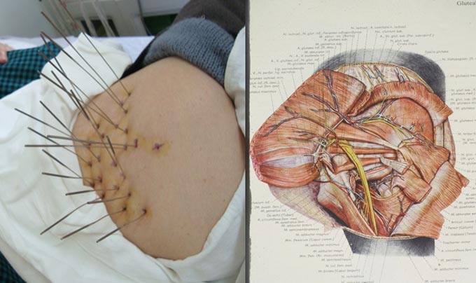 Silver Needle Thermal Conduction Therapy Instrument