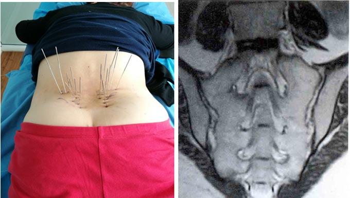 Silver Needle Thermal Conduction Therapy Instrument