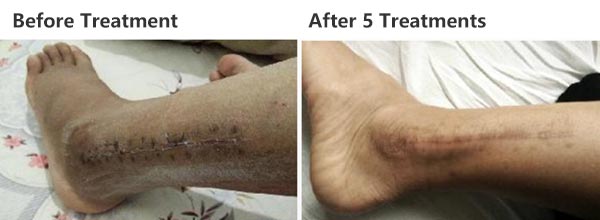 Semiconductor Laser Therapeutic Apparatus