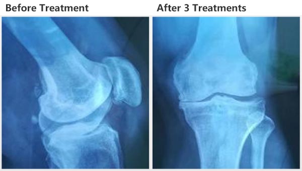 Semiconductor Laser Therapeutic Apparatus