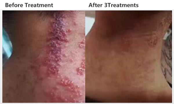 Semiconductor Laser Therapeutic Apparatus