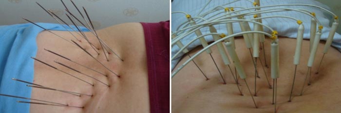 Silver Needle Thermal Conduction Therapy Instrument