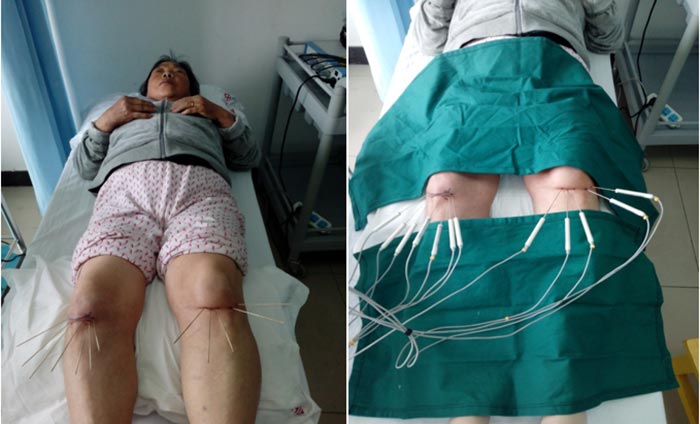 Silver Needle Thermal Conduction Therapy Instrument