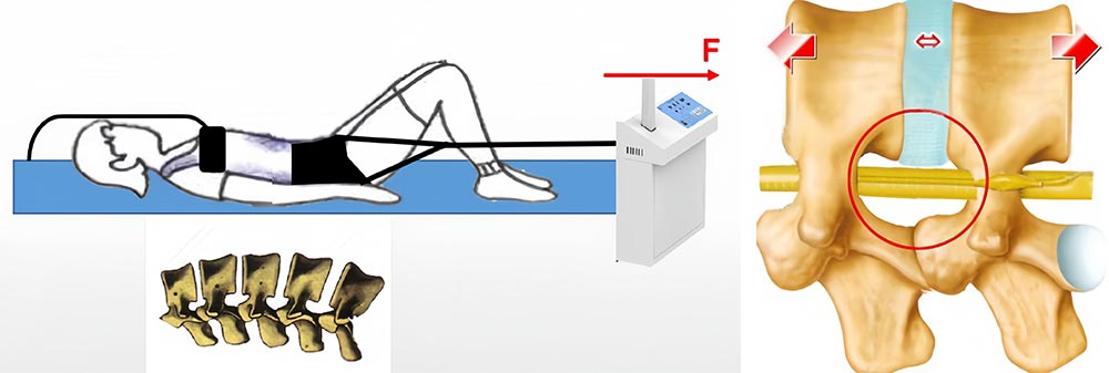 Electric Traction Bed