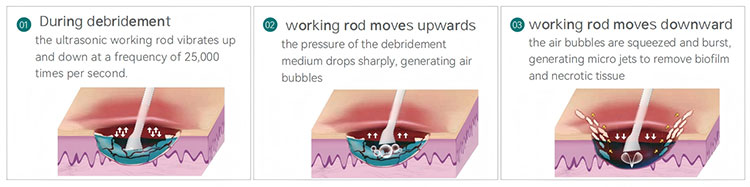 Multifunctional Debridement Instrument htsy